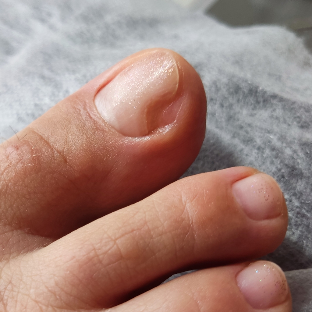 Зачистка онихолизиса