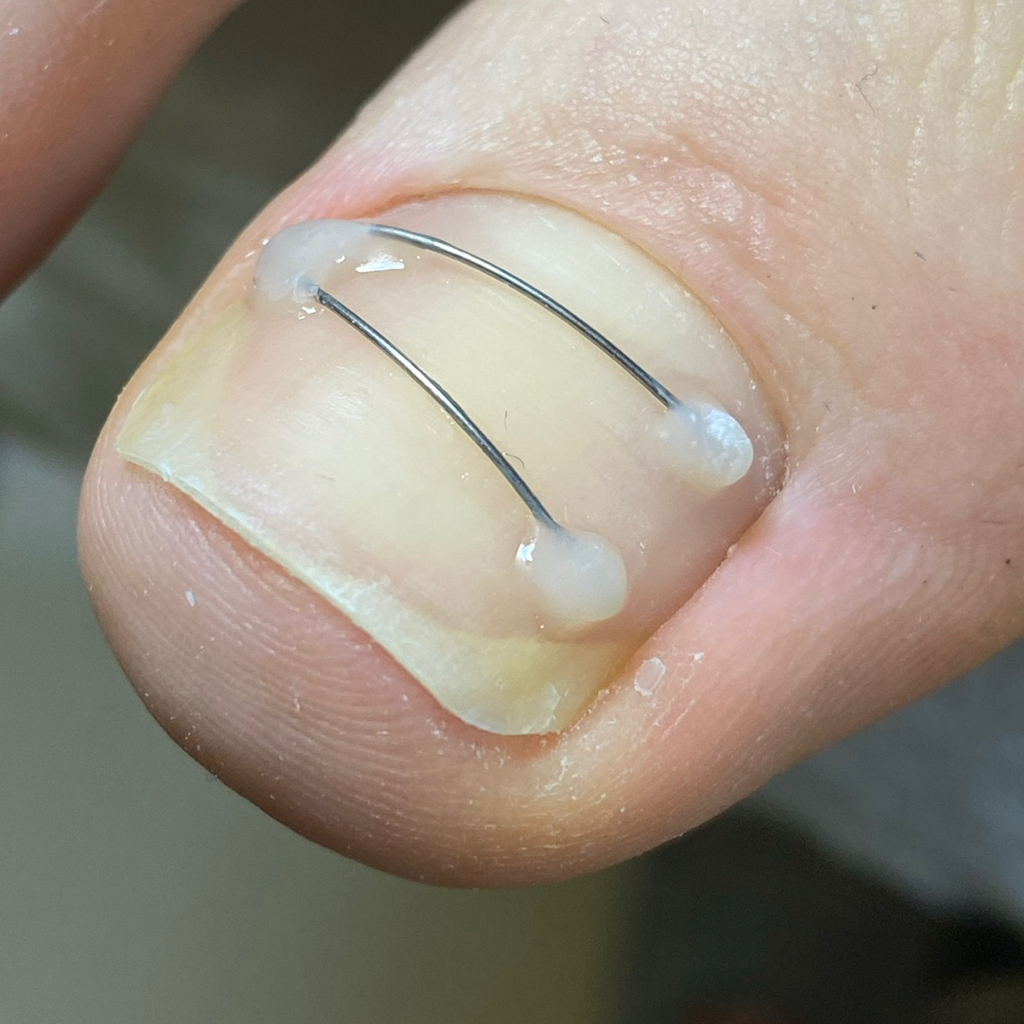 Установка титановой нити