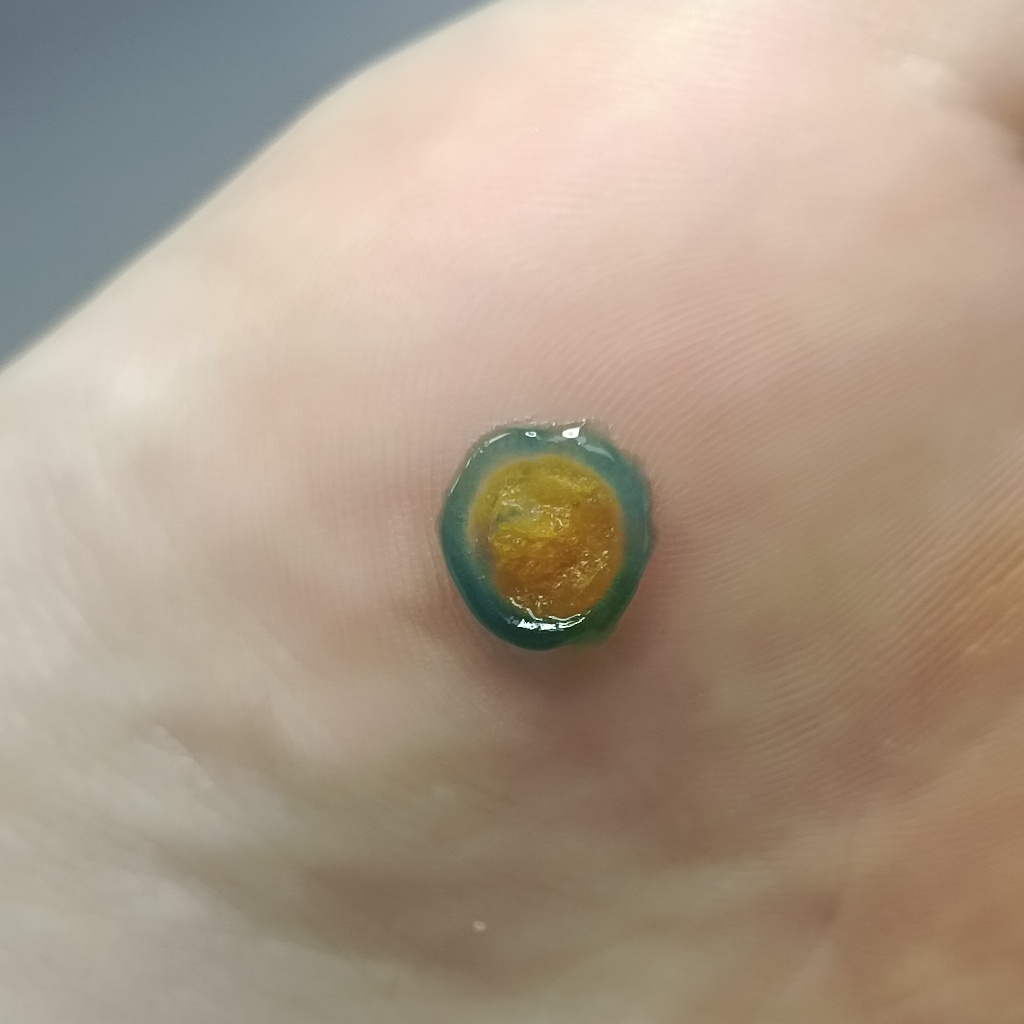 Обработка бородавки (1 штука)