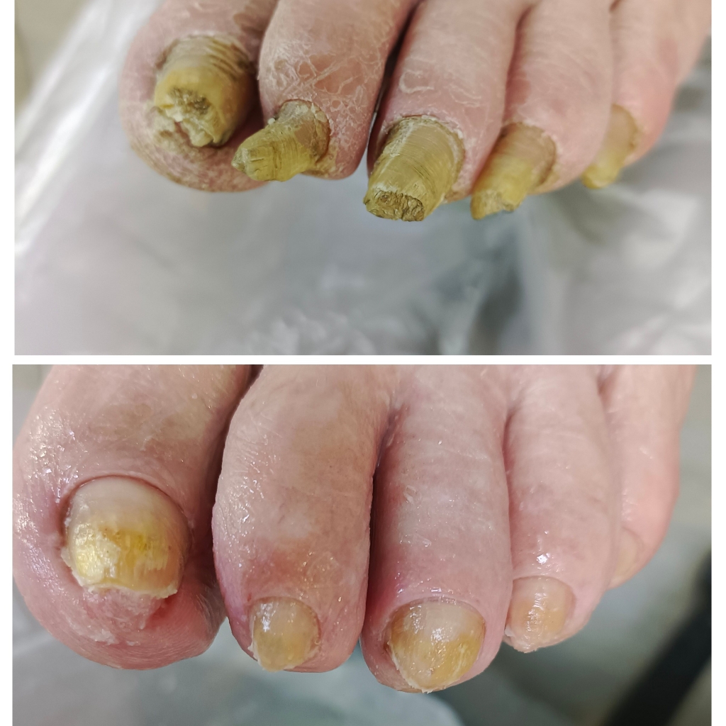 Подологический педикюр 3 степени