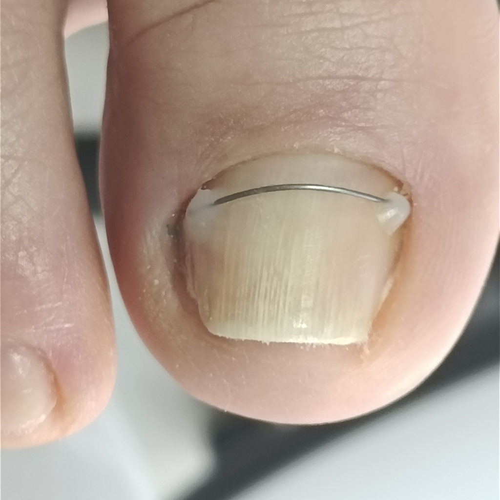 Коррекция ногтя титановая нить