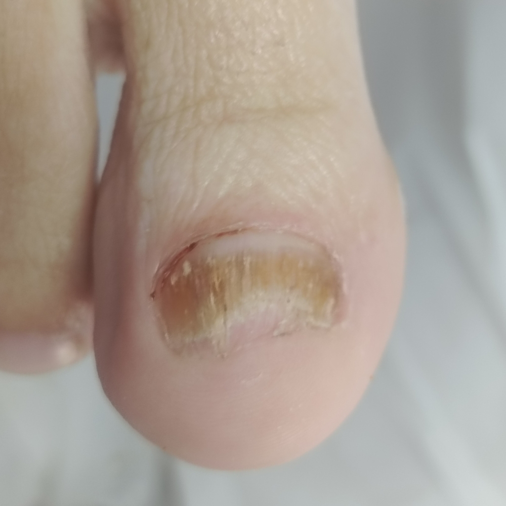 Чистка 1 ногтя