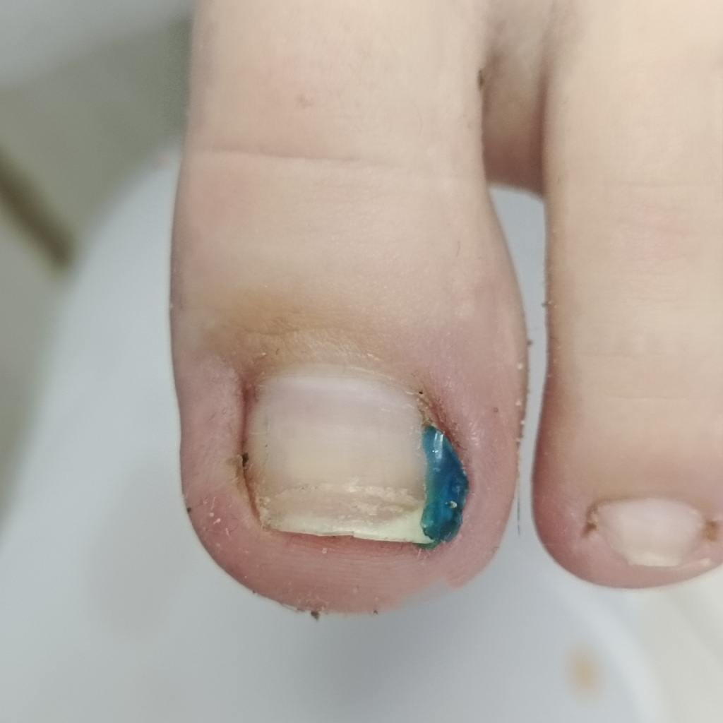 Тампонаж 1 пальчик