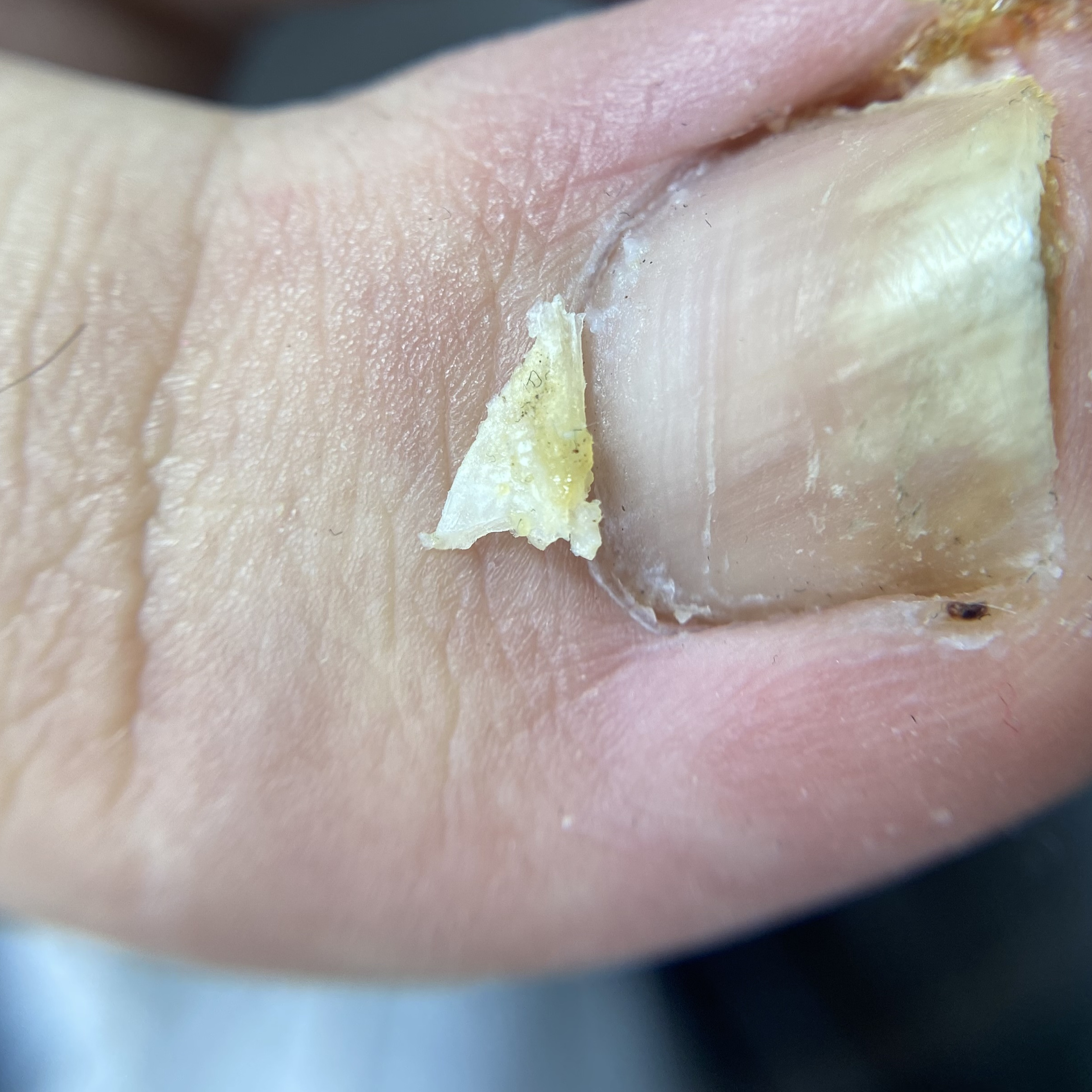 Профилактика вросшего ногтя