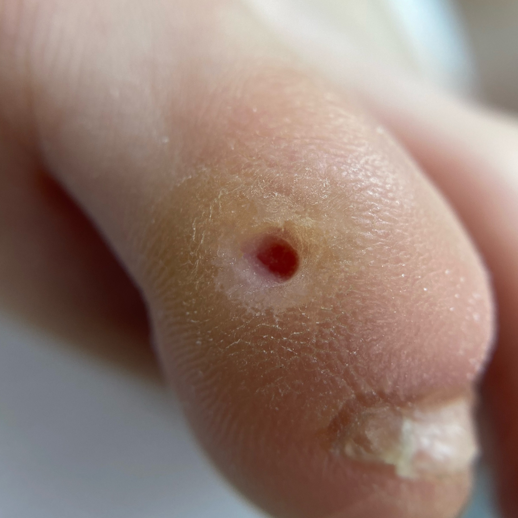 Стержневая мозоль