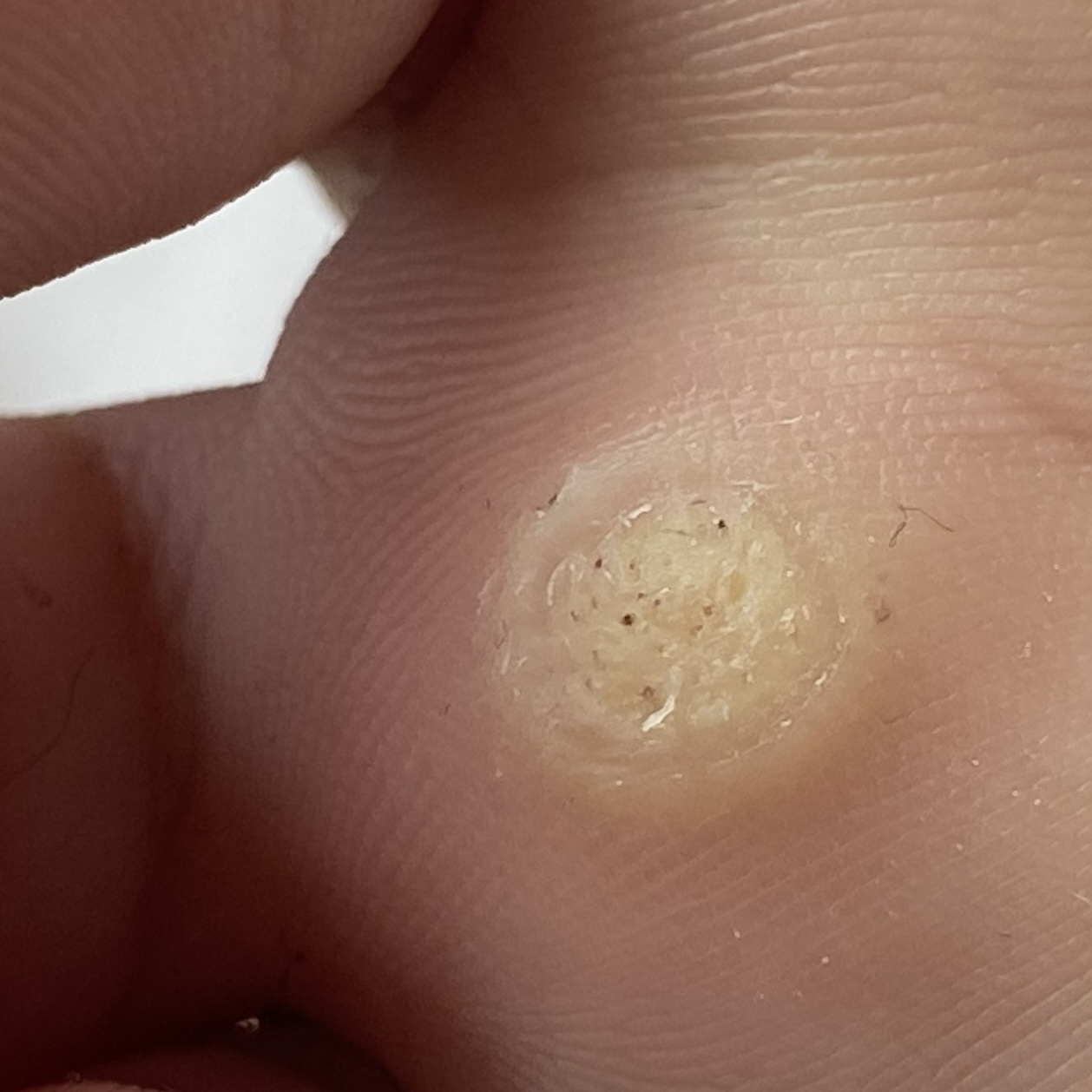 Обработка бородавки первичный прием