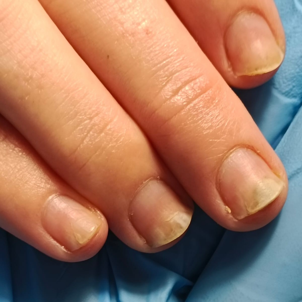 Маникюр парамедицинский 1 степени