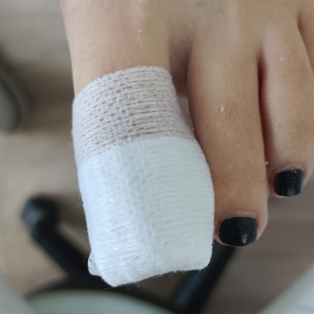 Обработка раны при вросшем ногте (повторная перевязка)