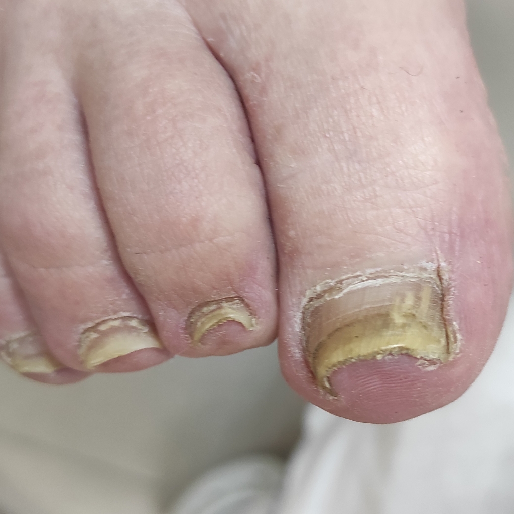 Обработка онихолизиса, онихогрифоза или микоза на ногах 7-10 ногтей