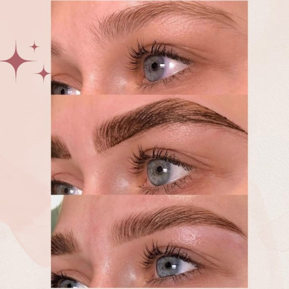 Ботокс бровей