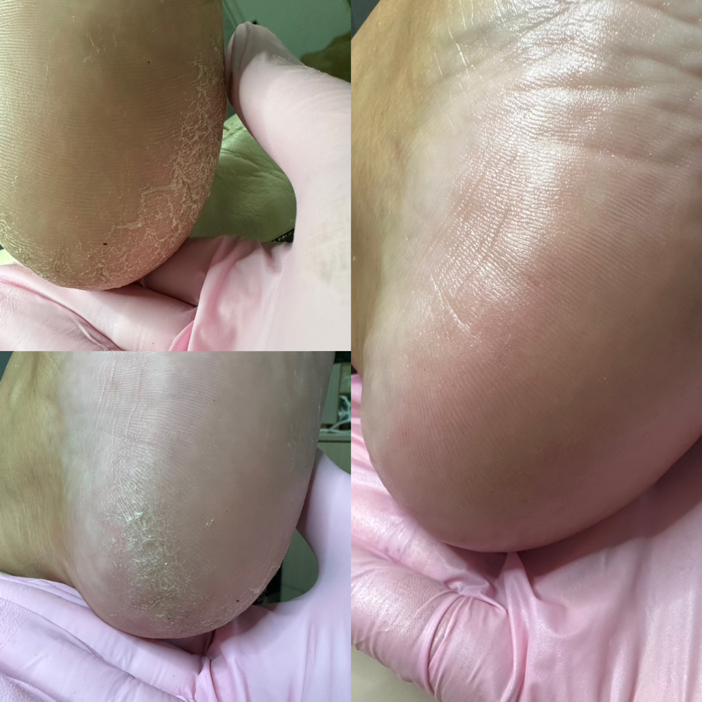 Педикюр на фруктовых кислотах