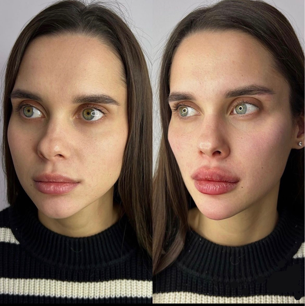 Ботулинотерапия FULLFACE