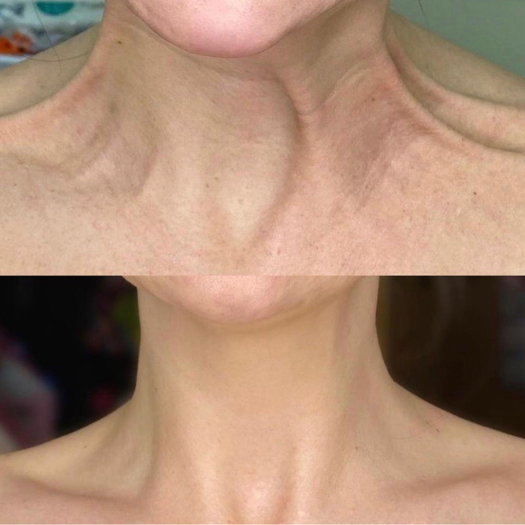 «Лифтинг Нефертити» ( шея)