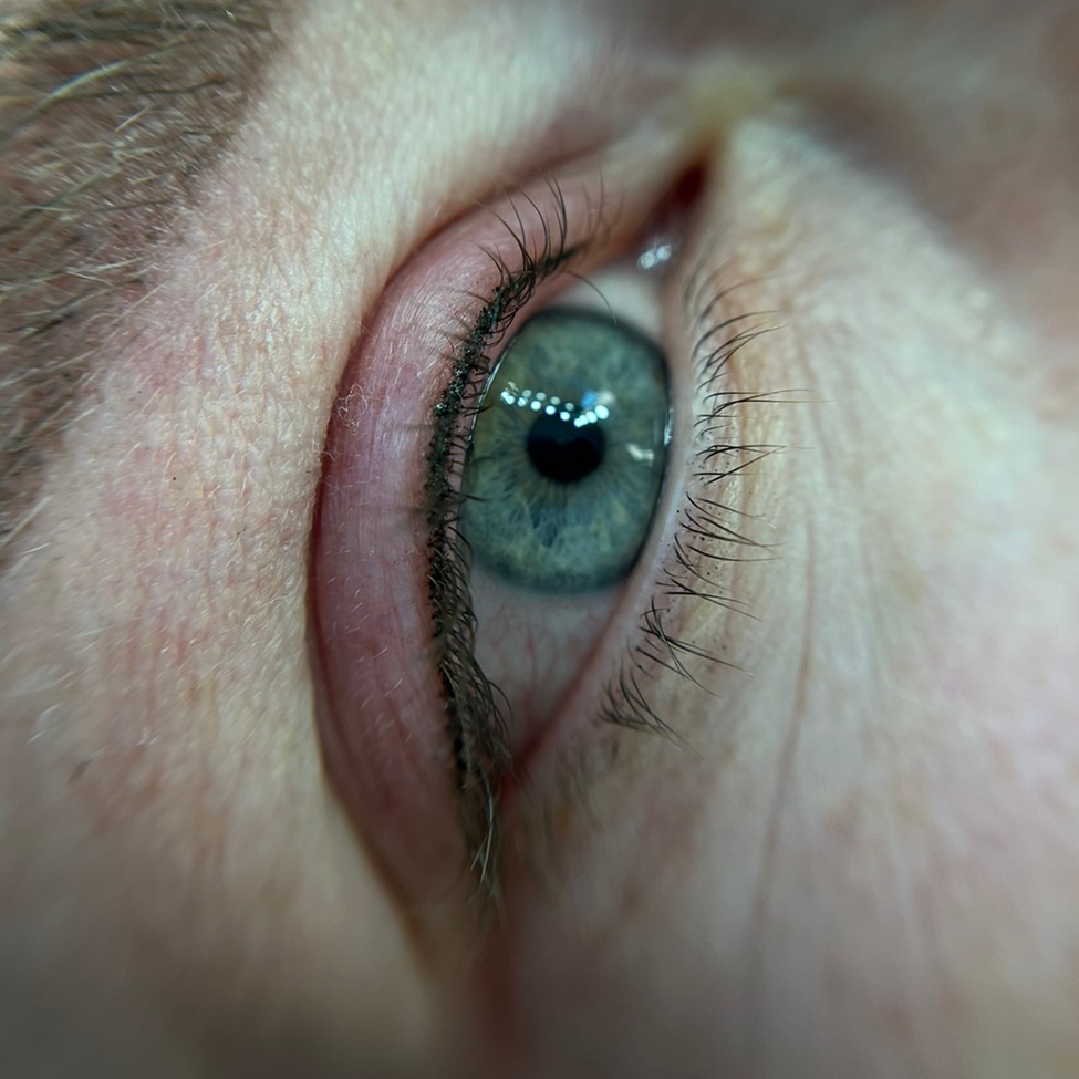 Коррекция ПМ межресничка