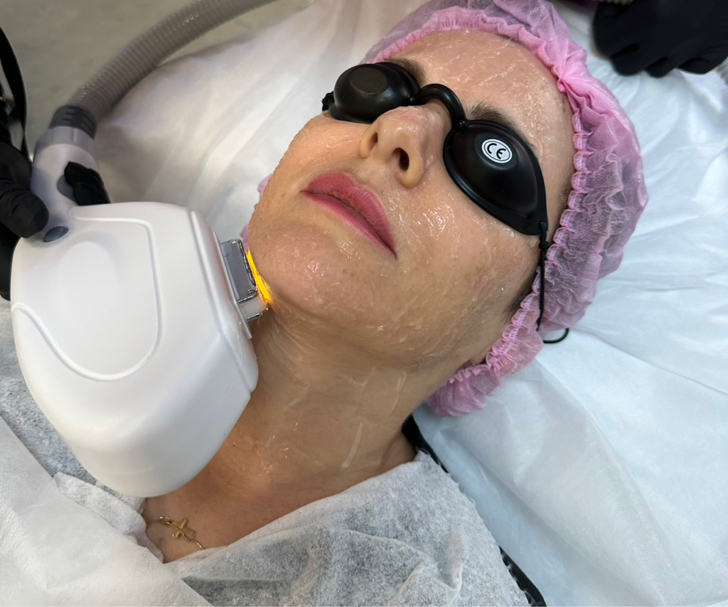 Фотоомоложение лицо+шея+декольте. IPL-терапия.