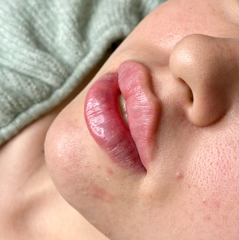 Увеличение губ Hyamax lips