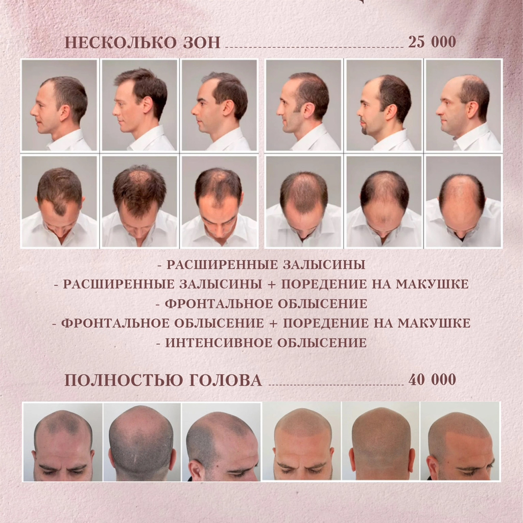 Дермопигментация головы (голова полностью)