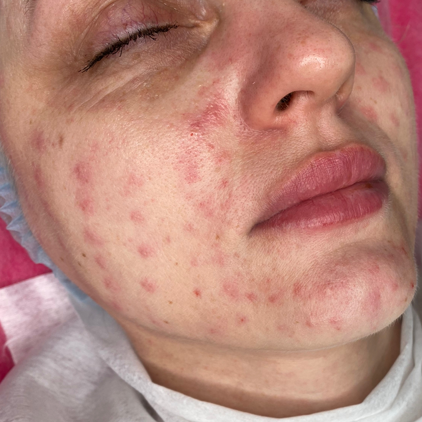 Биоревитализация Beautyfarma Hyal Франция