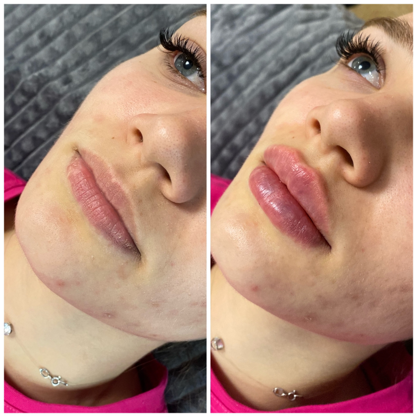 Увеличение губ Neuramis deep