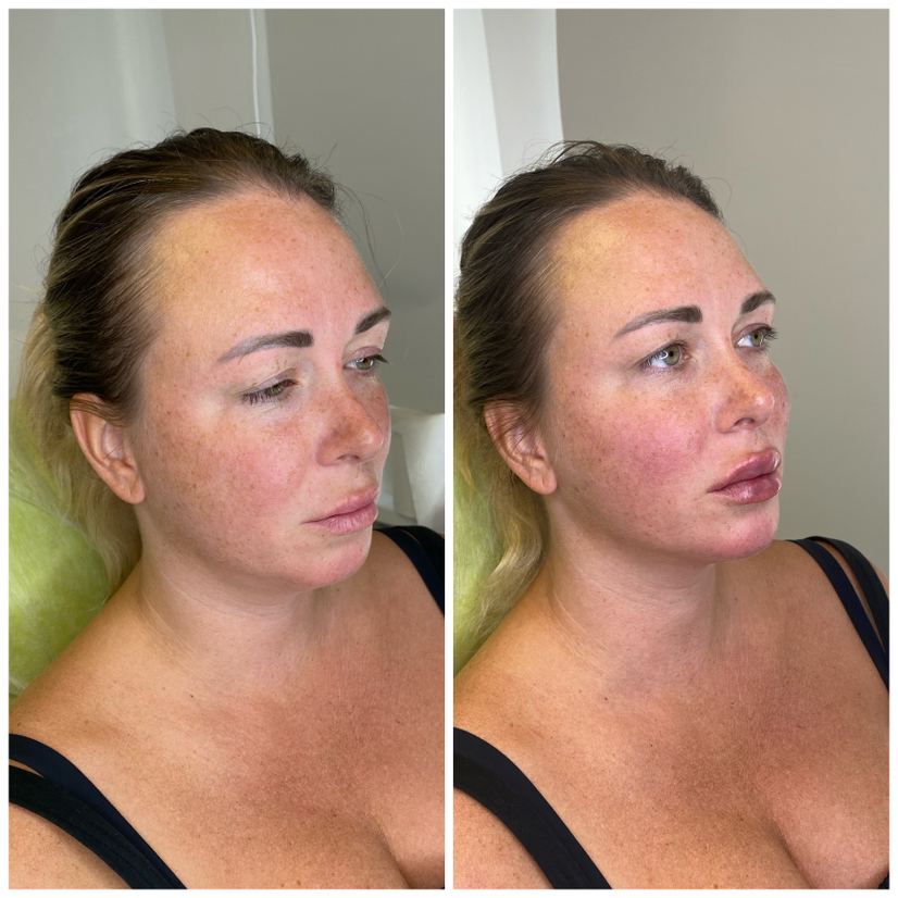 Full Face филлеры Швейцария Hyamax extra deep 6мл