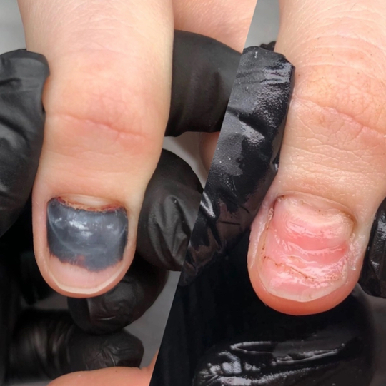 ПОДНОГТЕВАЯ ГЕМАТОМА