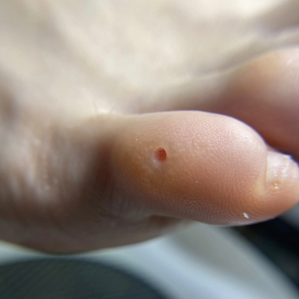 СТЕРЖНЕВАЯ МОЗОЛЬ