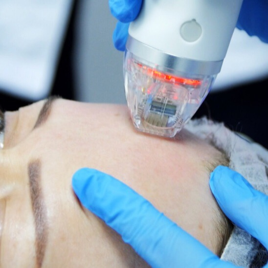 Микроигольчатый RF-лифтинг