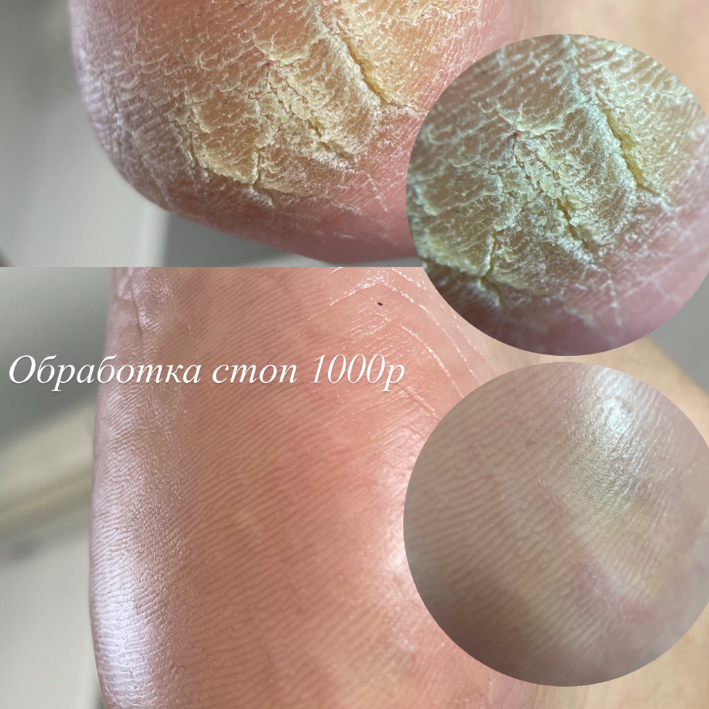 Обработка стоп