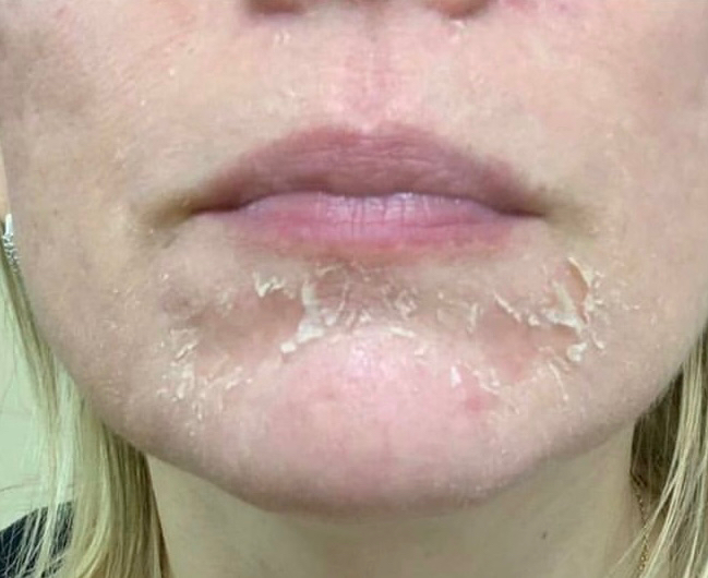 Срединный пилинг Джесснера (Голивудский пилинг)