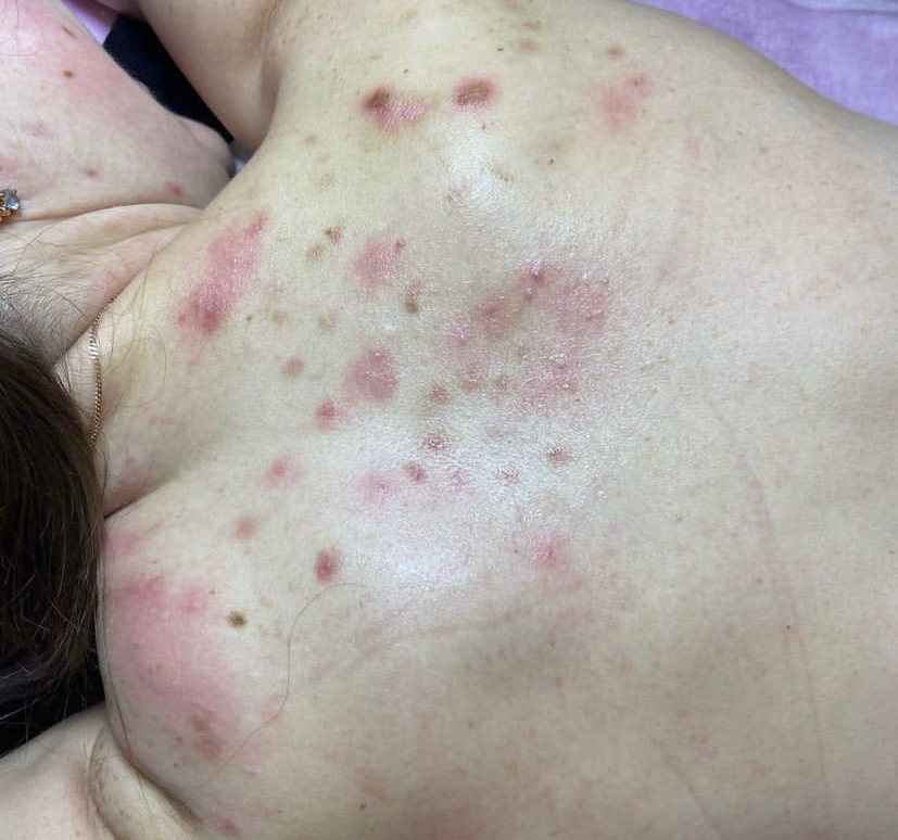 Комплексная чистка спины/груди