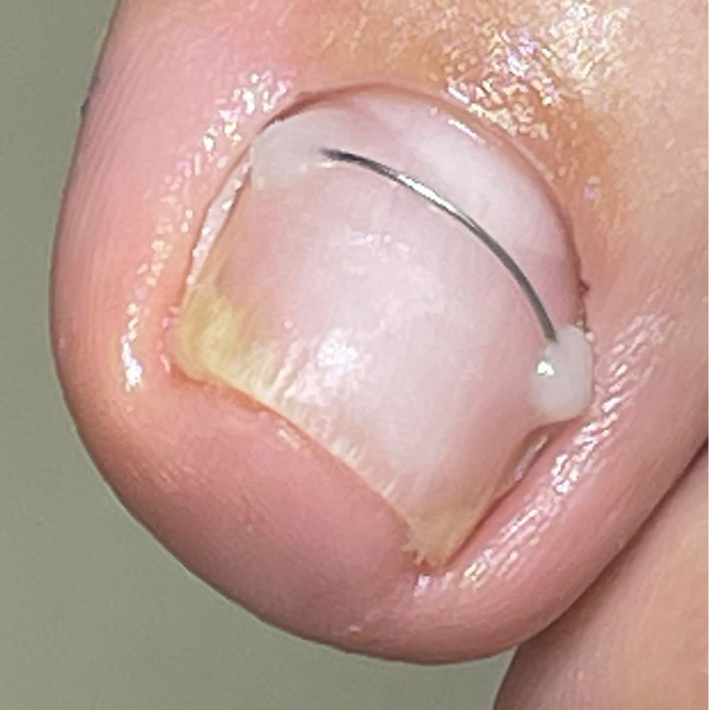 Установка титановой нити 1 ноготь