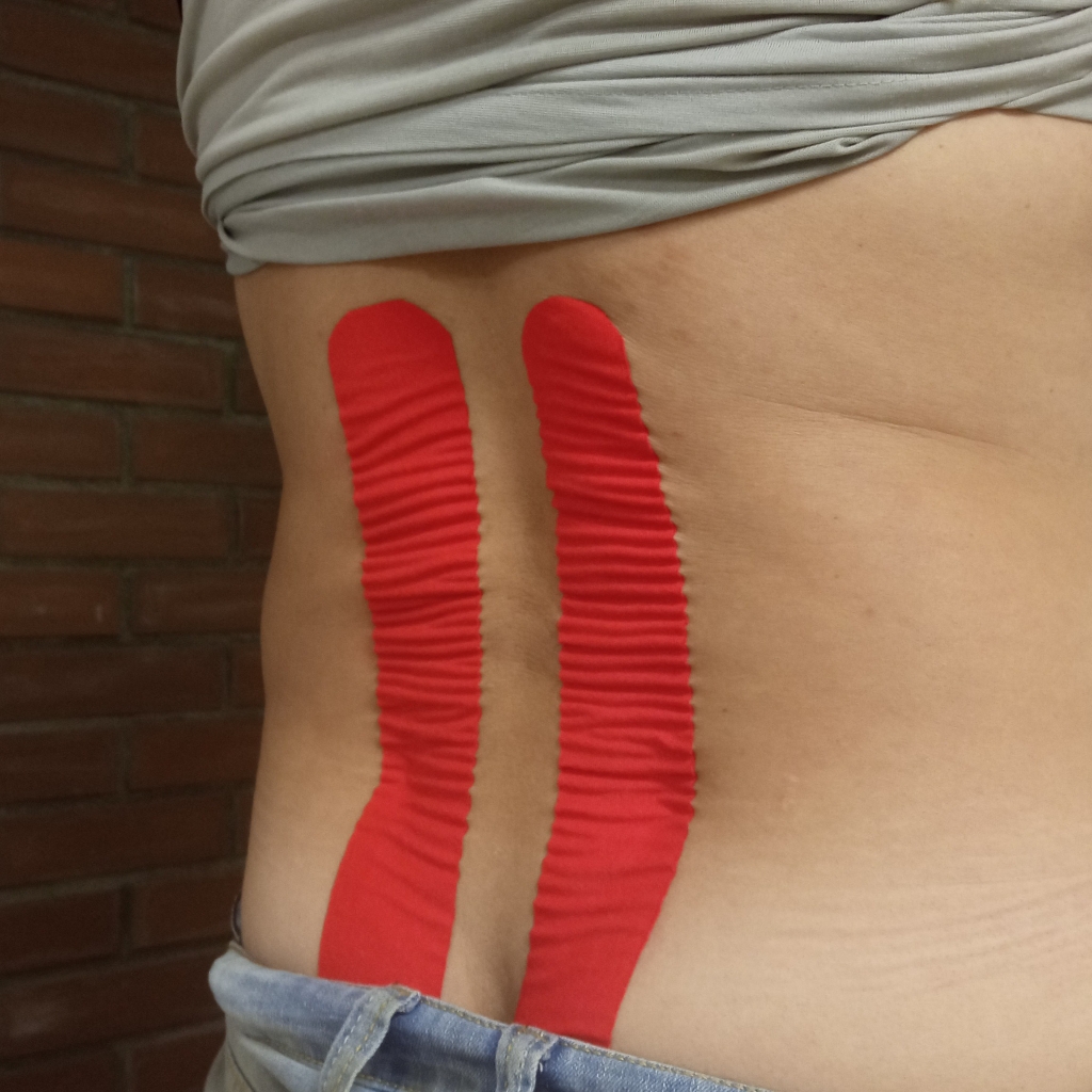 Тейпирование спины (болевой синдром)