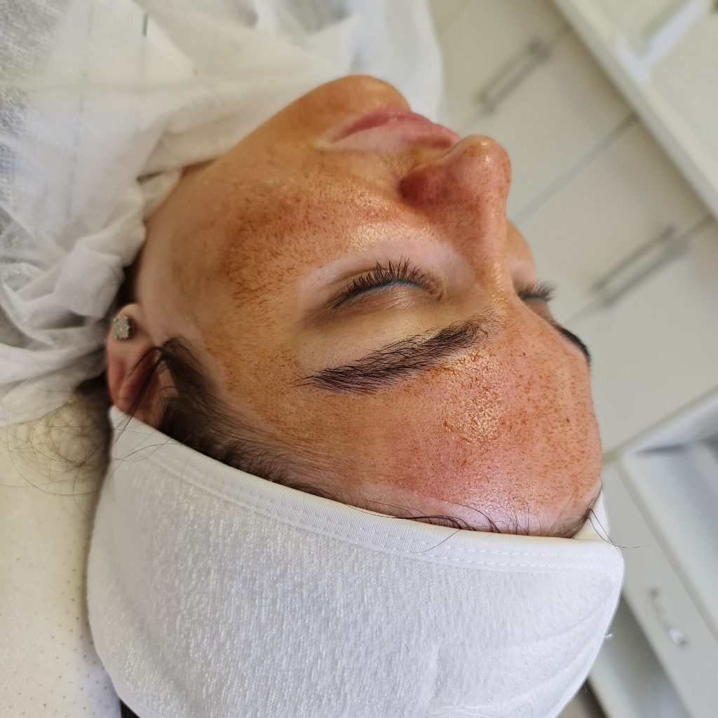 желтый пилинг