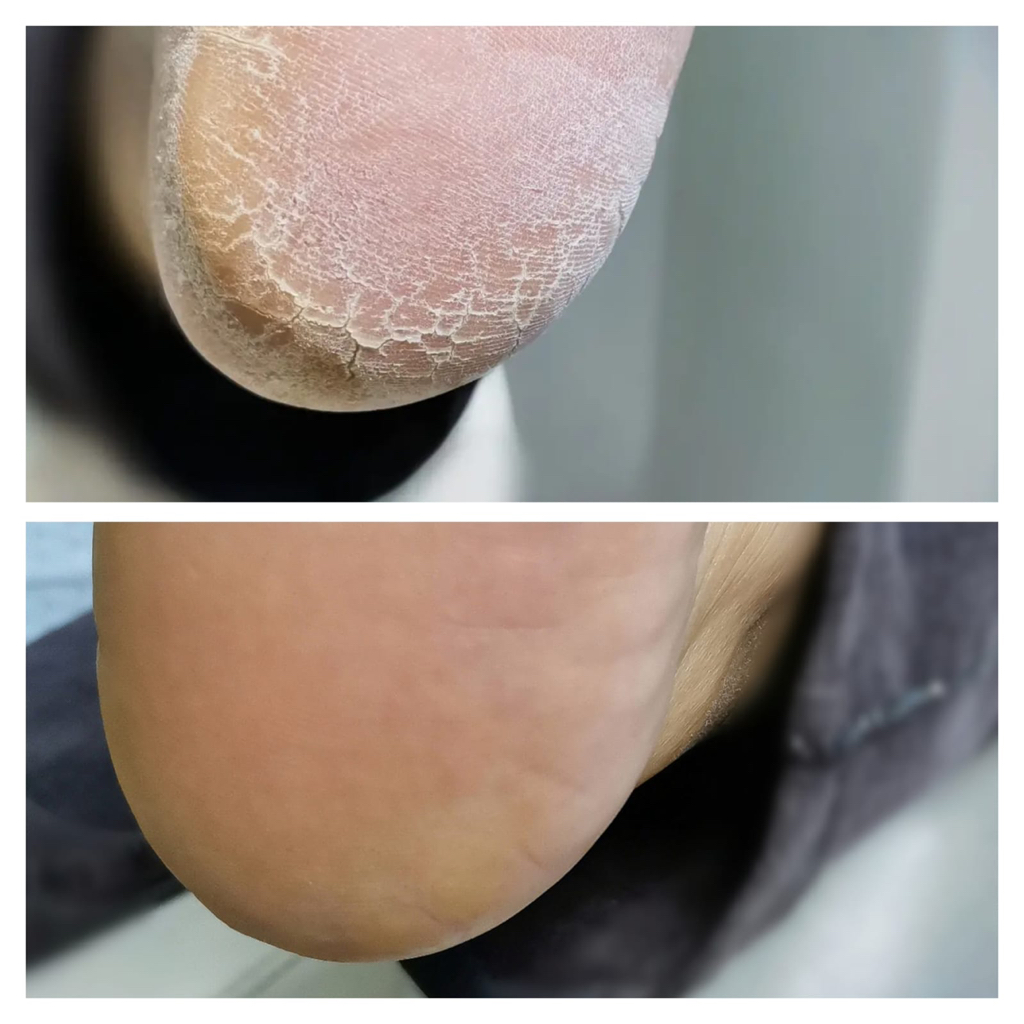 Педикюр (сложная стопа-трещины,стержневая мозоль)