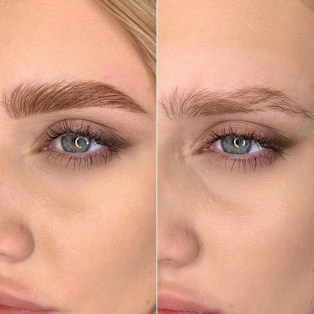 Ботокс для бровей