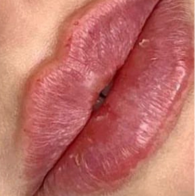 BABY RUSSIAN LIPS  (1/2 dose Juvederm 3)