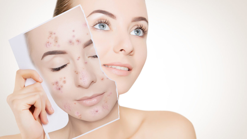 Anti ACNE терапия