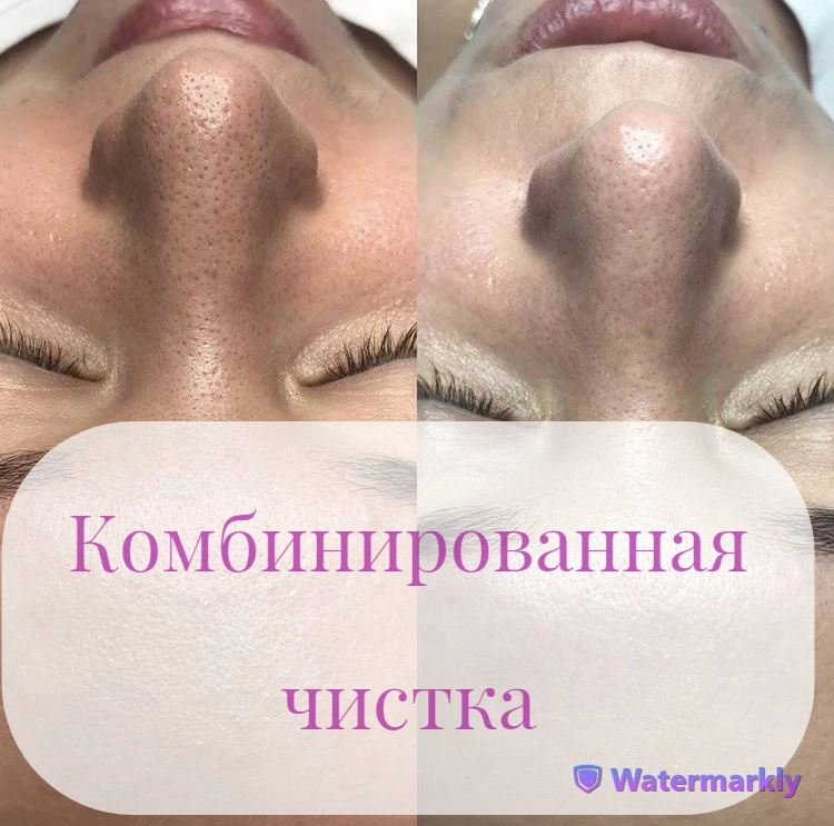 Комбинированная чистка