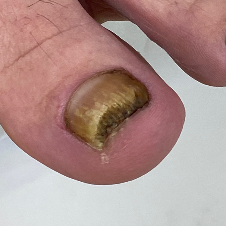 ДИАПЕДИКЮР  для пациентов с диагнозом САХАРНЫЙ ДИАБЕТ