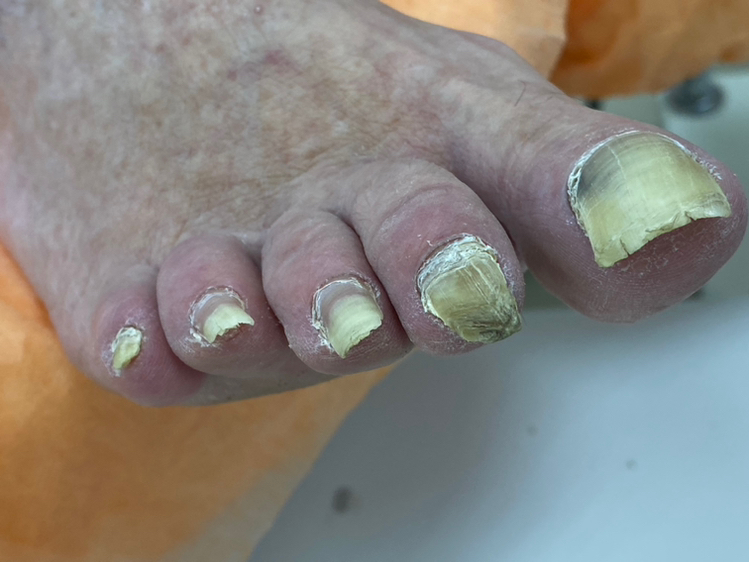 ПЕДИКЮР МЕДИЦИНСКИЙ  3 категория (грибковая инфекция) пальчики + стопы