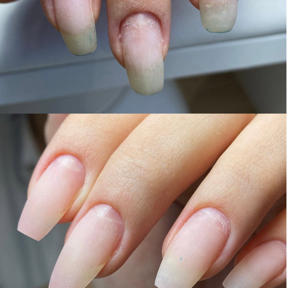 Укрепление акригелем