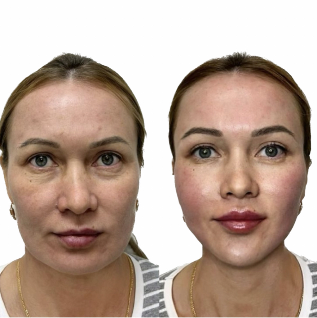 Full face (филлер, филлер+ботокс, под ключ)