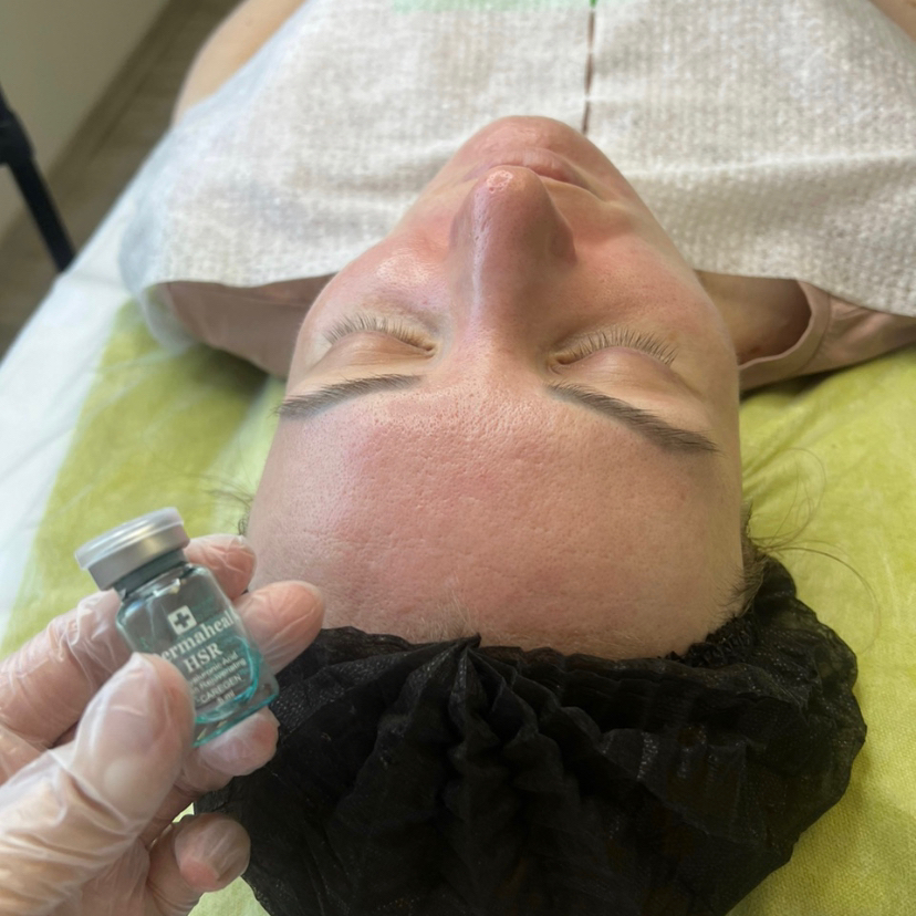 Биоревитализация Fusion Испания