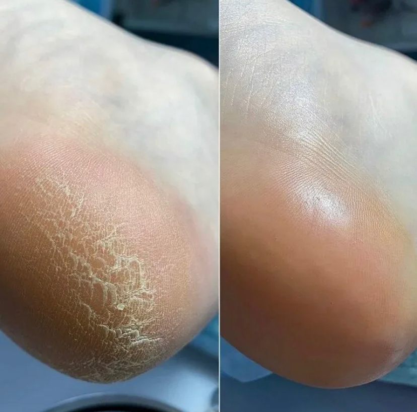 Пяточки Смарт