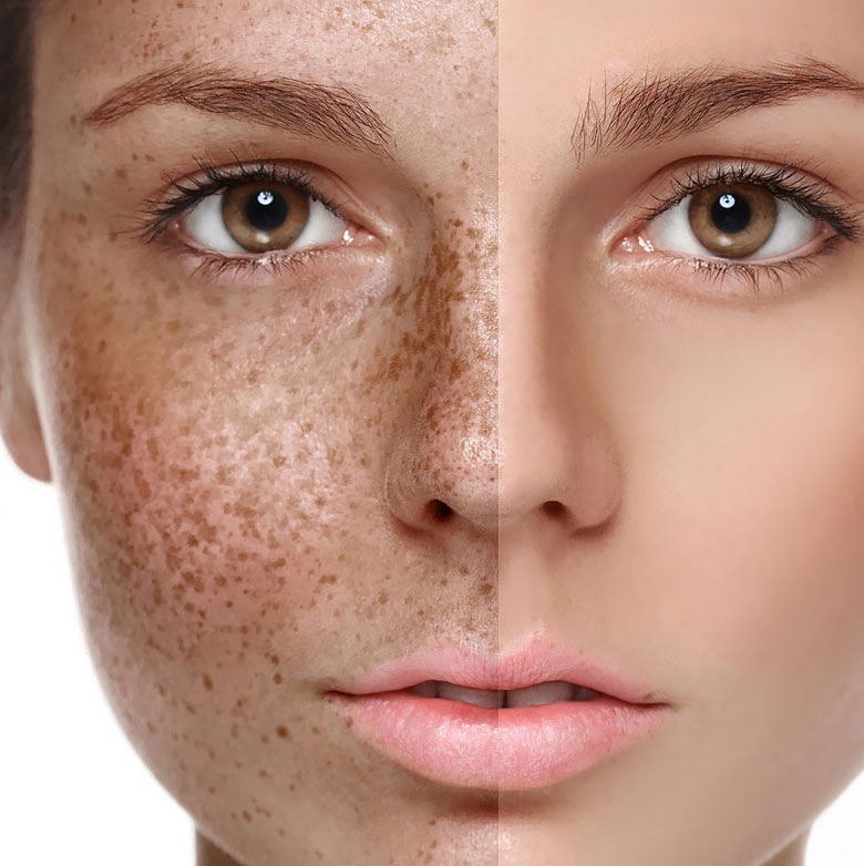 Удаление пигментации