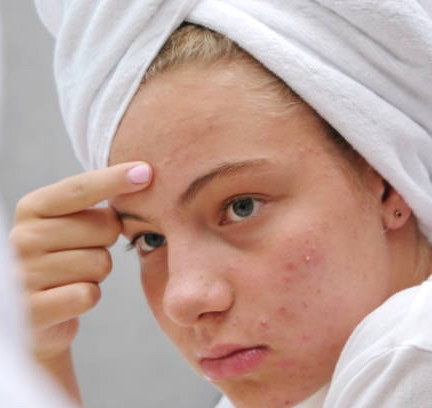 Коррекция акне и постакне: лицо