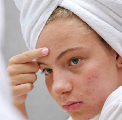 Коррекция акне и постакне: лоб