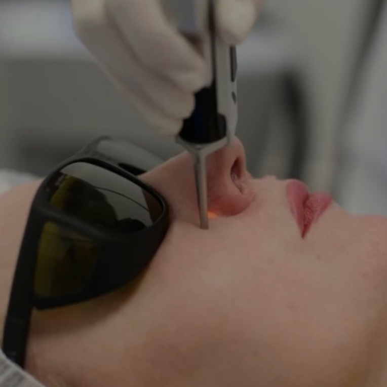 Лазерное удаление сосудов, купероза, телеангиэктазий