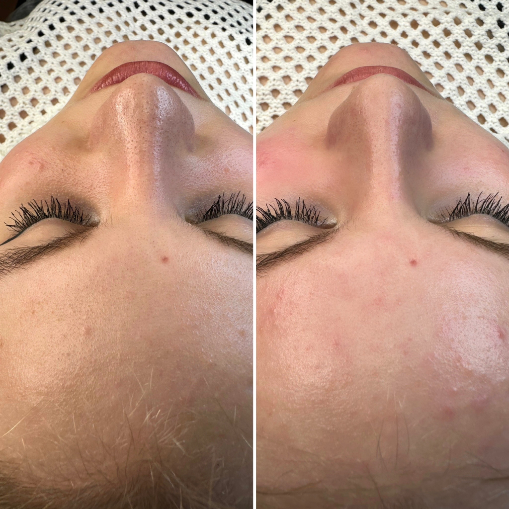 Чистка лица