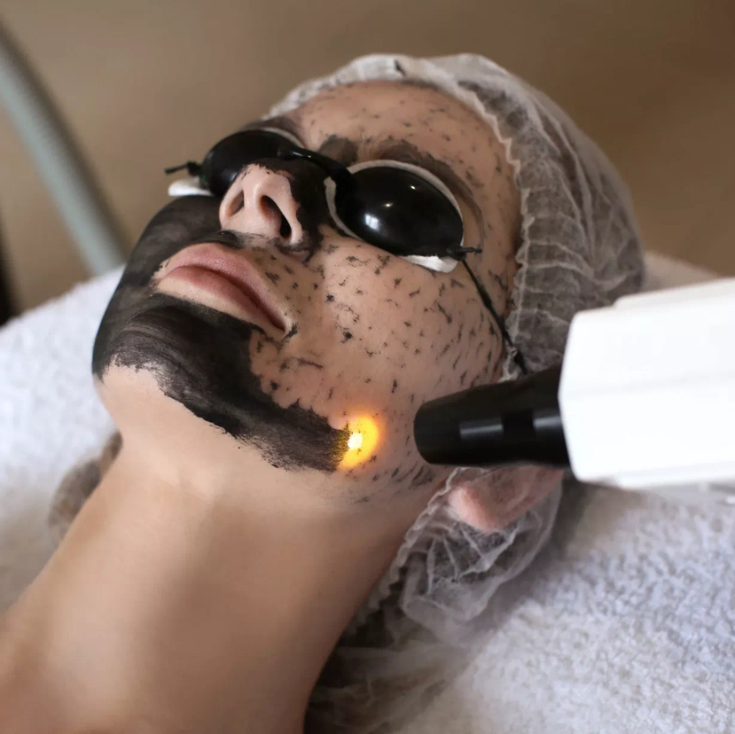 Лазерная чистка: комбинированная чистка лица + карбоновый пилинг